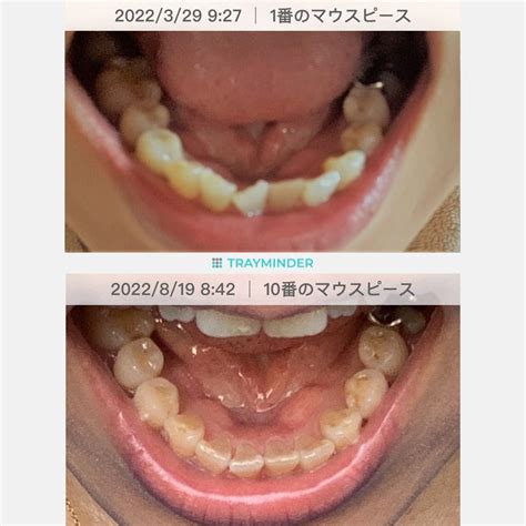 50代の歯列矯正 インビザライン 今さらなんて思わない！大人だって歯列矯正したい！