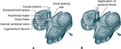 Postdural Puncture Headache Anesthesia Key