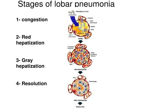 4 Stages Of Lobar Pneumonia