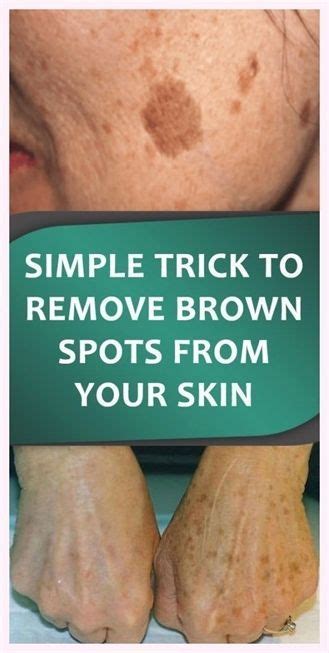 Simple Trick To Remove Brown Spots From Your Skin Brown Spots On Face Spots On Face Dark