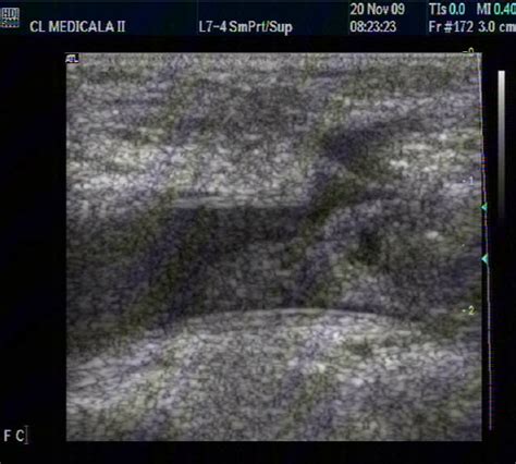 Thombosis Of Femoral Vein In A Patient With PC 2D Echographic