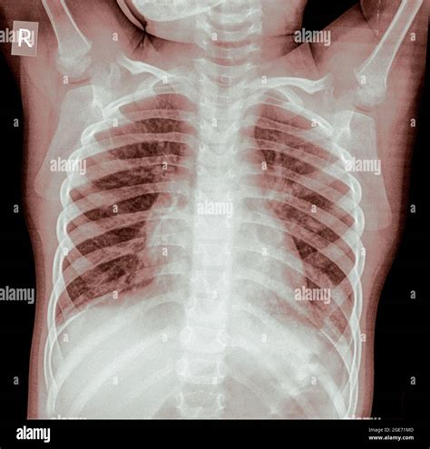 Infant Chest X Ray Normal At Annette Linda Blog