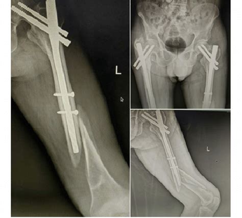 Pre Operative X Rays Showing Peri Implant Fracture Of The Left Femur