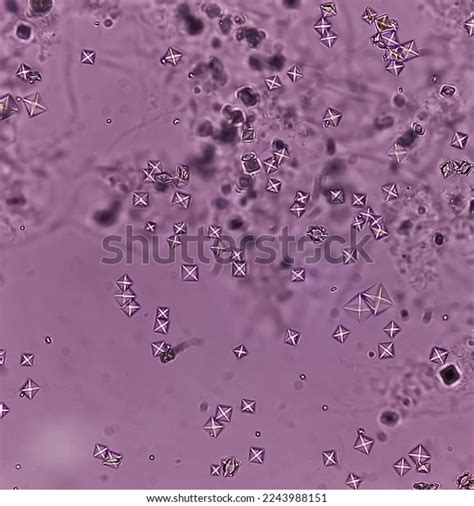 Microscopic Image Showing Calcium Oxalate Crystals Stock Photo