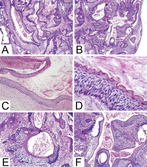 Solid Variant Of Keratocystic Odontogenic Tumor With Ameloblastomatous