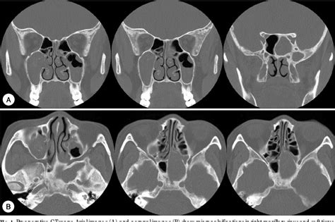 Figure 1 From A Case Of Multiple Discrete Fungus Balls Of The Bilateral Paranasal Sinuses