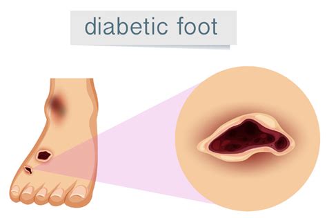 Diabetic Foot Problems Symptoms Treatment And Care