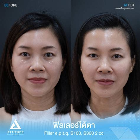 รีวิว Attitude Clinic ห้วยขวาง รีวิวฉีดฟิลเลอร์ใต้ตา Eptq S300