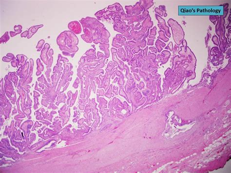 Qiao S Pathology Papillary Adenoma Of The Gallbladder Intracystic