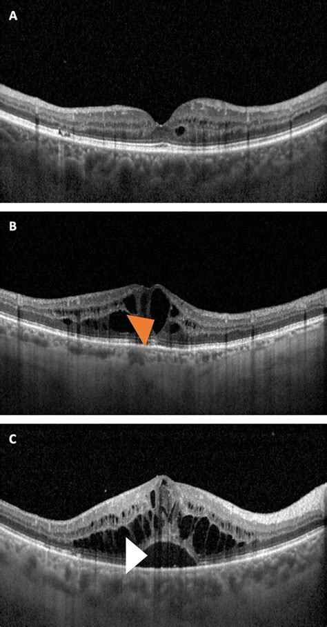 Clinical images showing structural OCT representations of the DME ...