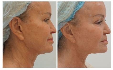 Sofwave™ Near Seattle Eyebrow And Neck Lift Treatment Wayne Larrabee Md