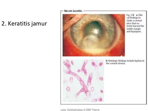 Klasifikasi Keratitis Delinewstv