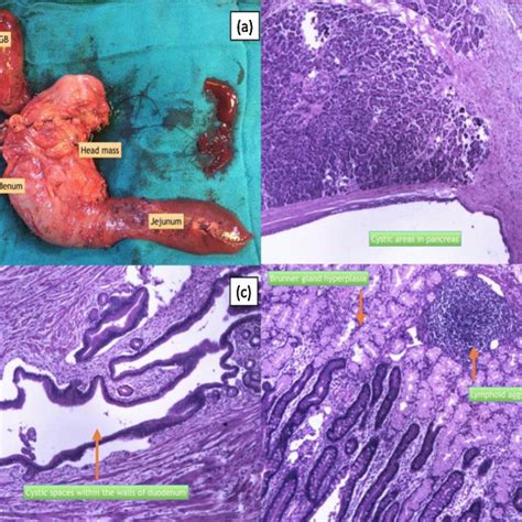 (PDF) Groove pancreatitis: A Pancreatic Dilemmoma