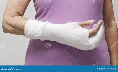 Woman S Hand In Bandage And Cast Stock Image Image Of Bandage Cast