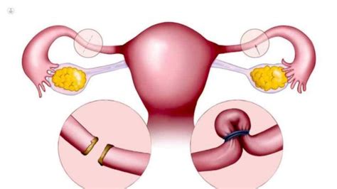 Qu Es La Ligadura De Trompas Detalles Sobre Esta Cirug A Top Doctors