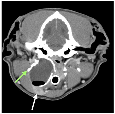 Salivary Mucocele