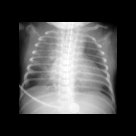 Hypoplastic Left Heart Syndrome With Atrial Septal Defect Pacs