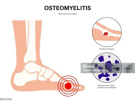 Osteomyelitis Of Feet Stock Illustration Download Image Now Acute Angle Anatomy Ankle Istock