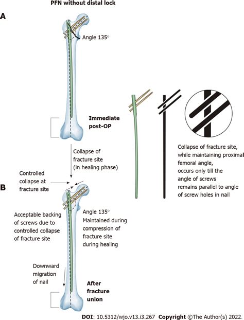 Comparative Study Of Intertrochanteric Fracture Fixation Using Proximal