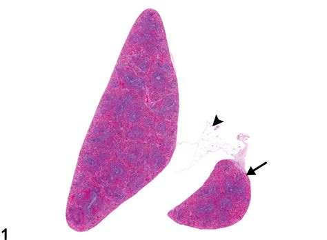 Spleen Accessory Spleen Nonneoplastic Lesion Atlas