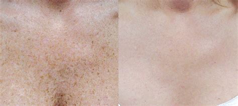 Laser Pigmentation Removal Canterbury And Kent The Grove Clinic