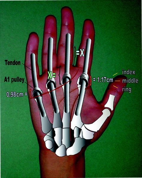 Management And Referral For Trigger Fingerthumb The Bmj