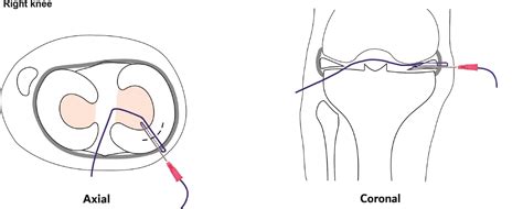 SciELO Brasil Microinvasive Meniscal Suture With Disposable Needle