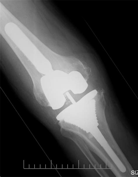 Knee Replacement And Revision Surgeries Orthopaedicsurgerys