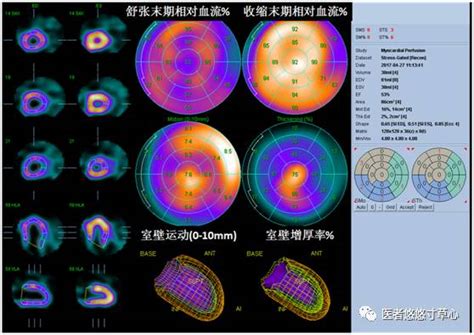 前沿探查心脏微循环血流的新神器 PET心肌灌注显像 搜狐