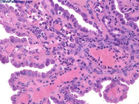 Nephrogenic Adenoma Microscopic Cells Histology Slides Bladder