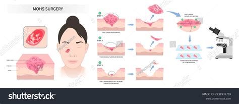 Facial with Mohs surgery basal cell microscopic - Royalty Free Stock Vector 2231932759 - Avopix.com