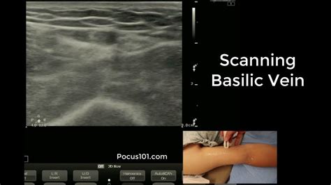 Scanning The Basilic Vein With Ultrasound Youtube