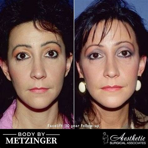 Before & After - Facelift Photos - Case 9