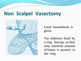 No Scalpel Vasectomy PPT