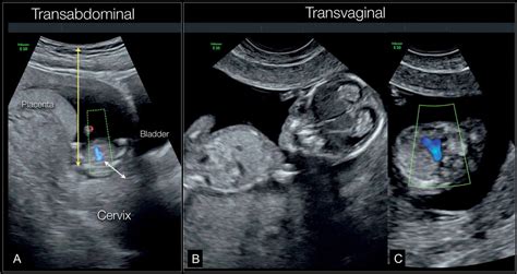 Fetal Cardiac Examination In Early Gestation Obgyn Key