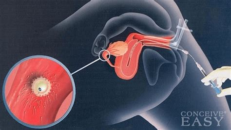 Intrauterine Insemination In Iran Iui Treatment Ariamedtour