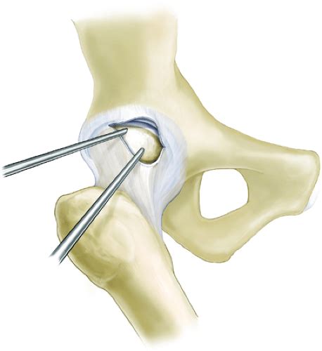 Hip Arthroscopy Supine Position Musculoskeletal Key