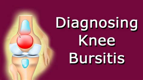 Diagnosing Knee Bursitis Youtube