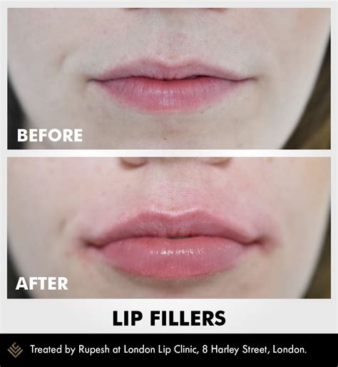 Lip Fillers London Lip Fillers Lips Juvederm Lips