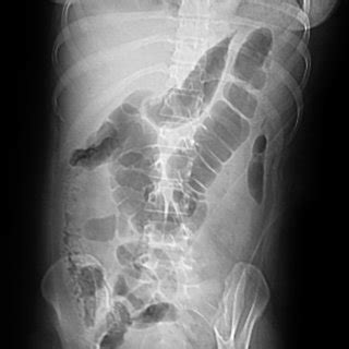 18: Pancreatic necrosectomy in progress | Download Scientific Diagram