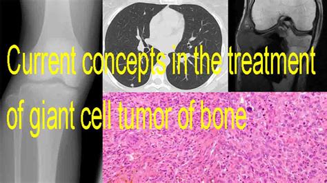 Cancers Free Full Text Current Concepts In The Treatment Of Giant Cell Tumors Of Bone