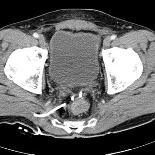 PDF A Case Of Successful Percutaneous Drainage Of A Pelvic Abscess