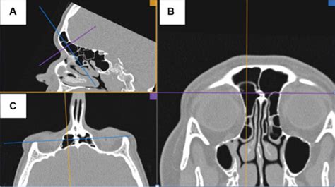 SciELO Brazil The Frontal Sinus And Frontal Recess Anatomical