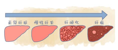 对照！导致肝癌的因素中，你接触了哪些？如何预防肝病？收藏！也百科