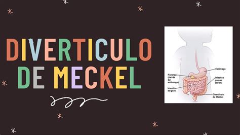 Diverticulo De Meckel Y Malformaci N Anorectal Reviews Medicos Udocz