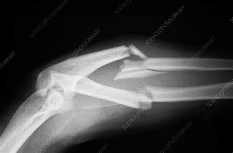 Angulated And Comminuted Fracture Stock Image C027 2663 Science