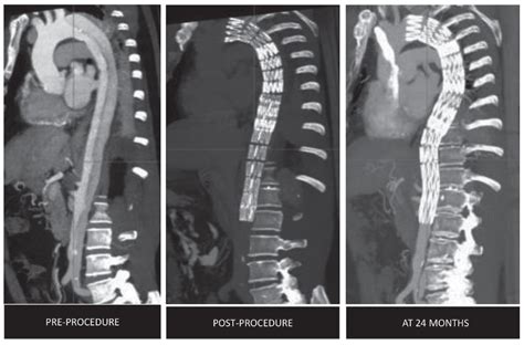 Aortic Dissection X Ray