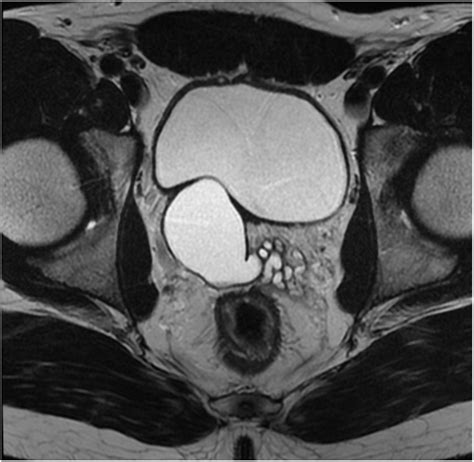 Axial T2 Weighted Mri Image Showing A Large 49 × 33 × 42 Mm Cyst Of