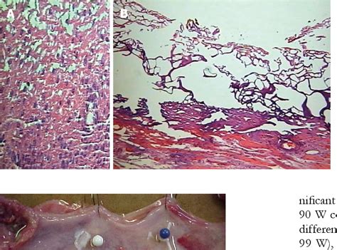 Figure From Histology Assessment Of Bipolar Coagulation And Argon