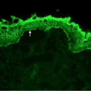 Indirect Immuno Fluorescence Of 1 M NaCl Split Foreskin Showing IgG